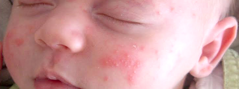 Paediatric Skin Disorder