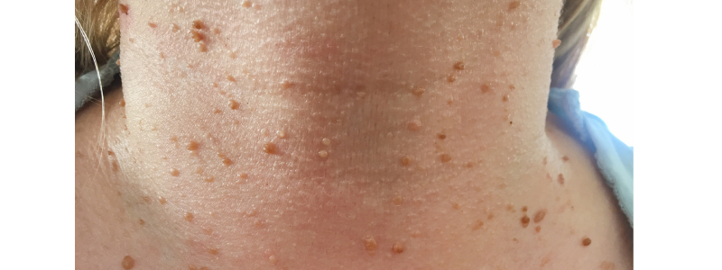 Skin Growths Removal in Nerul